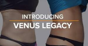 Is Venus Legacy Permanent